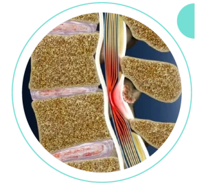 Espondilolistese | Dr. Allan Garcia - Ortopedista em Brasília