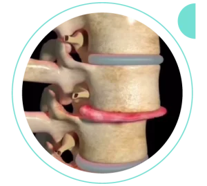Estenose do canal lombar | Dr. Allan Garcia - Ortopedista em Brasília