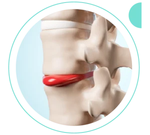 Hérnia de Disco | Dr. Allan Garcia - Ortopedista em Brasília