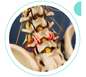 Artropatia facetária | Dr. Allan Garcia - Ortopedista em Brasília